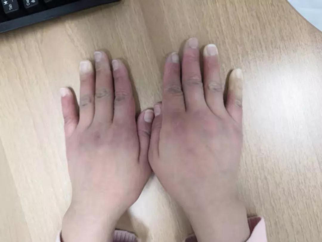 “手指、腳趾發(fā)白、發(fā)紫……”這些“小毛病”千萬(wàn)別大意