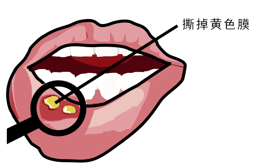 經(jīng)?？谇粷?，真的只是缺維生素嗎？