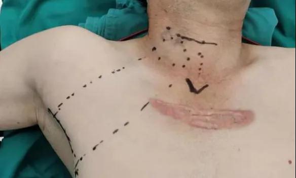 術(shù)后傷口可以“隱身”嗎？