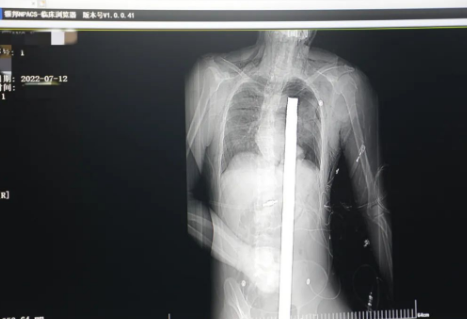 1.2米長的鋼筋貫穿男子胸腹！情況極度危險(xiǎn)......