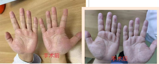 胸外科專家微創(chuàng)手術根治“手汗” 助患者重返社交圈