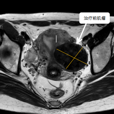 保子宮、保留生育功能—磁波刀治療子宮肌瘤