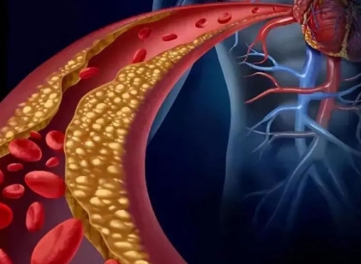 警惕！冠脈支架術(shù)后這些誤區(qū)千萬別踩，趕緊收藏！